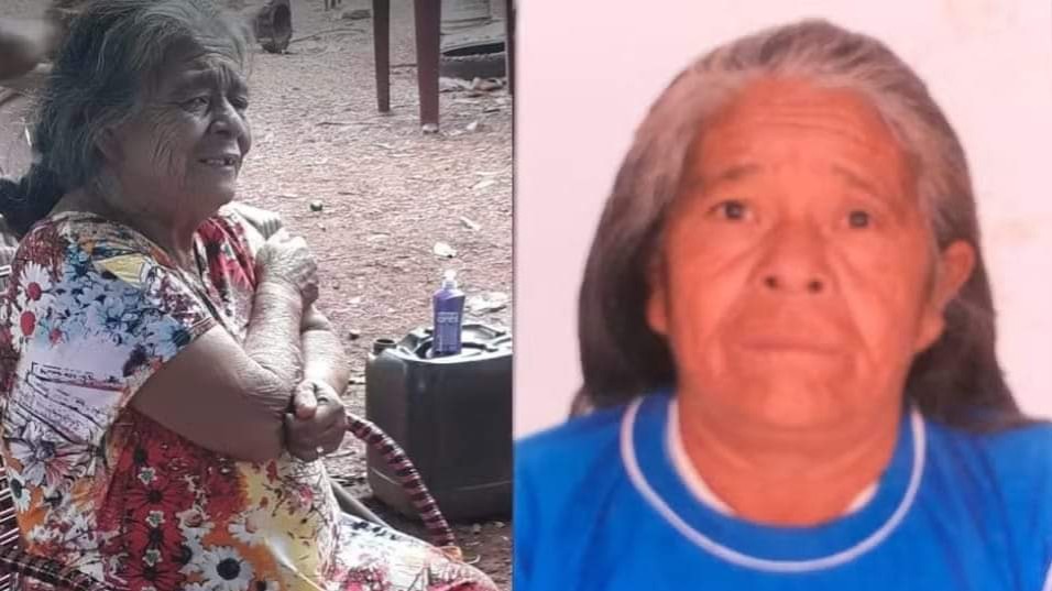 Feto calcificado estava alojado fora do útero e mulher suspeitava de tumor