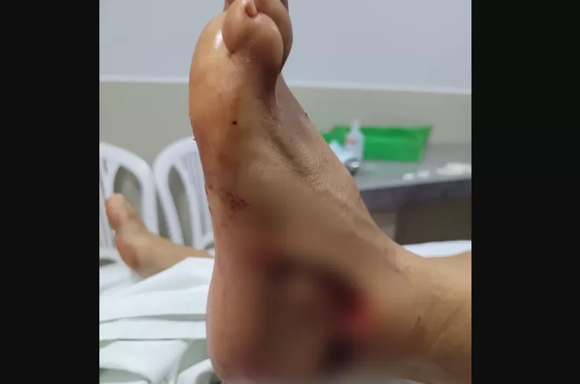 Turista é atacado por peixe Dourado no pé e caso é avaliado como acidental