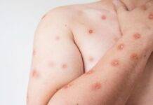 MS confirma caso de Mpox em homem de 27 anos