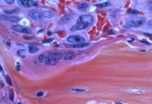 Câncer de cabeça e pescoço têm maioria de casos avançados no país