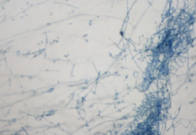 1º caso de fungo resistente a antifúngicos é registrado no Brasil