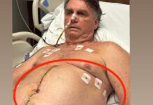 Bolsonaro posta foto de pontos da cirurgia e dreno; veja